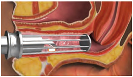 Nuevo tratamiento de la atrofia vaginal y la incontinencia urinaria leve