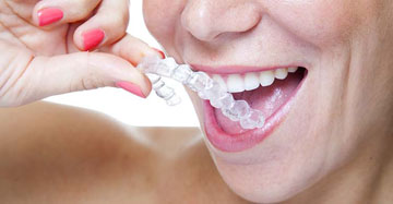 Invisalign